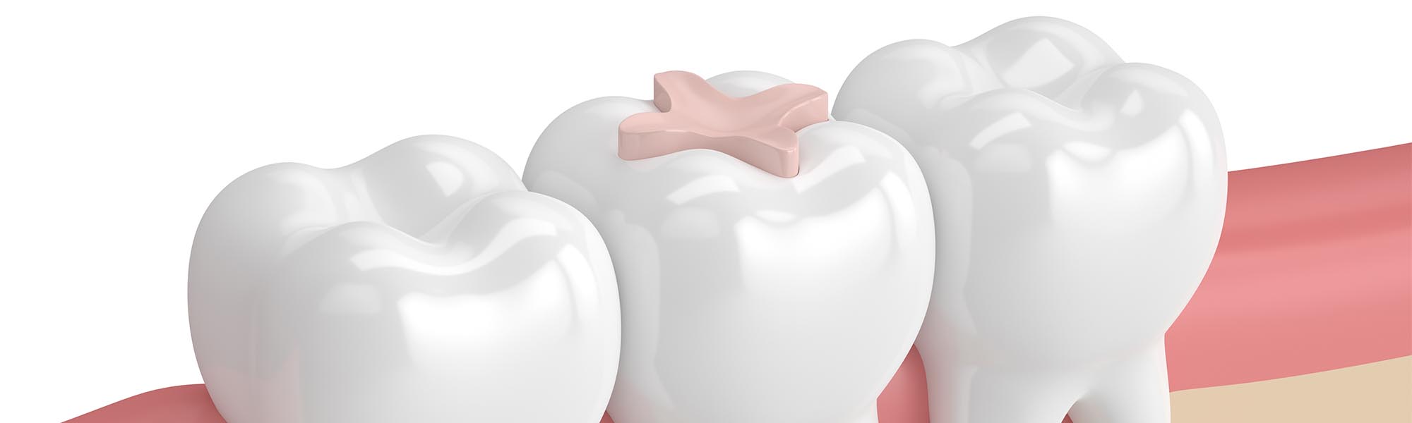 Restorative Inlays & Onlays Torrance CA