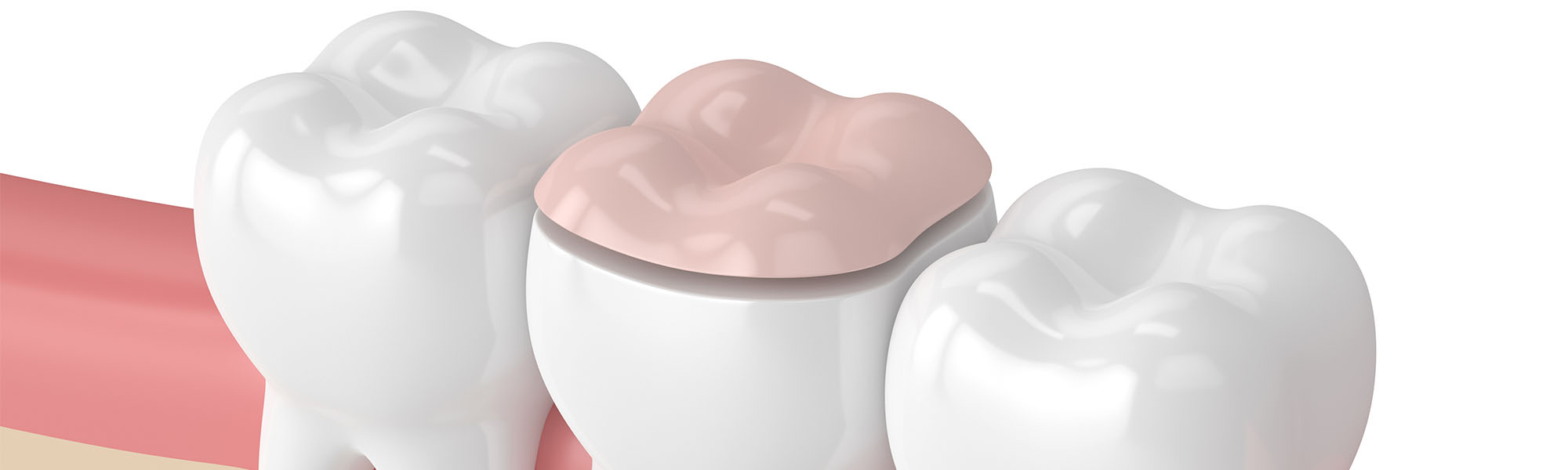 Porcelain Inlays & Onlays Torrance CA