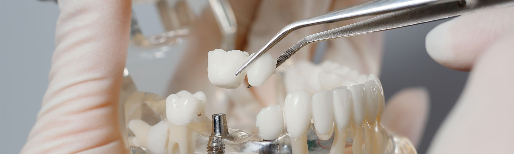 What Is the Best Fix for Missing Teeth? Torrance CA