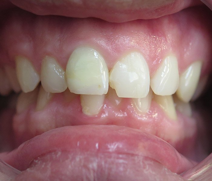 Before composite filling treatment, patient case 1 at Dentist of Torrance