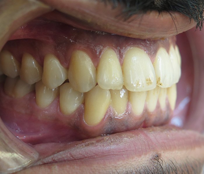 Before professional teeth cleaning, patient case 3 at Dentist of Torrance