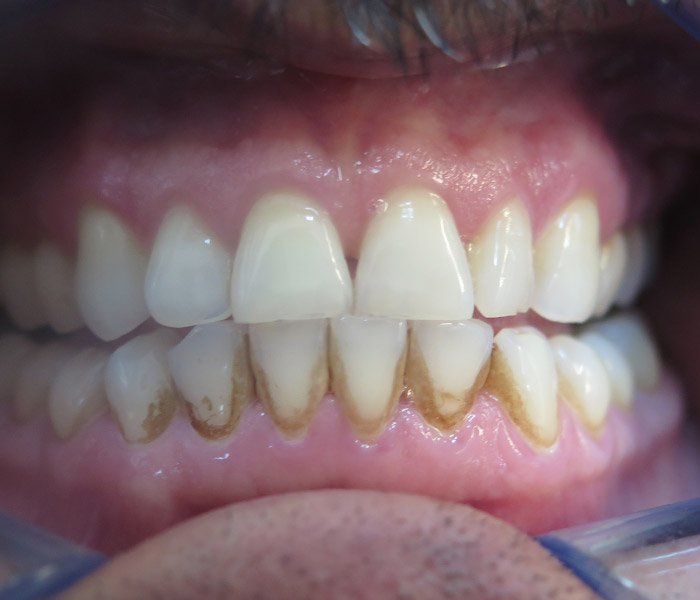 Before professional teeth cleaning, patient case 4 at Dentist of Torrance