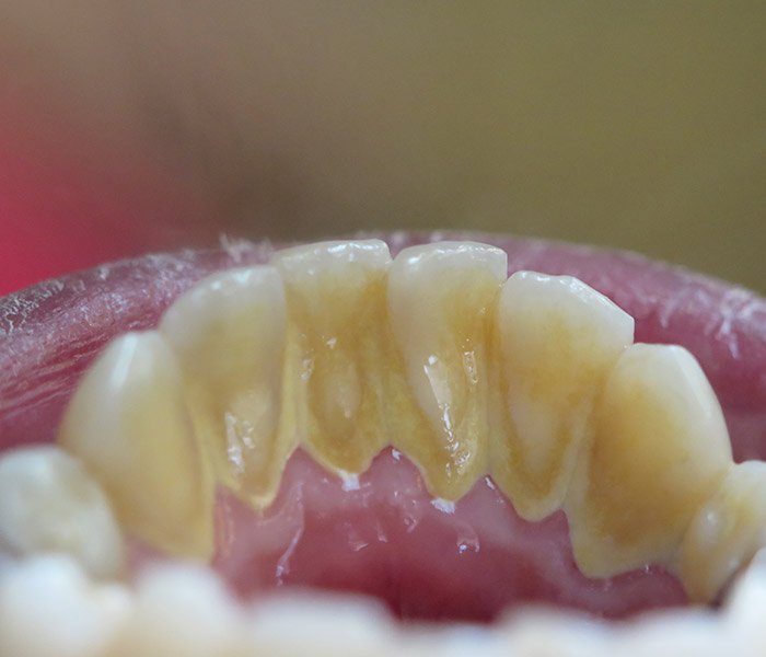 Before professional teeth cleaning, patient case 2 at Dentist of Torrance