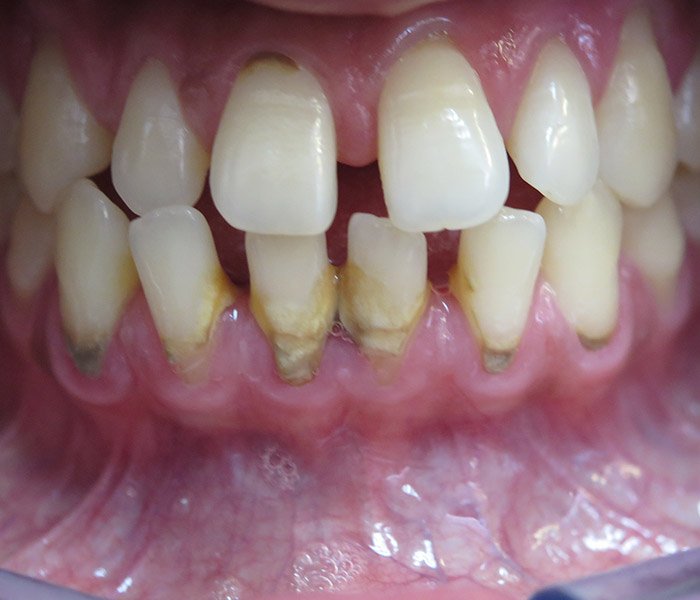 Before professional teeth cleaning, patient case 1 at Dentist of Torrance