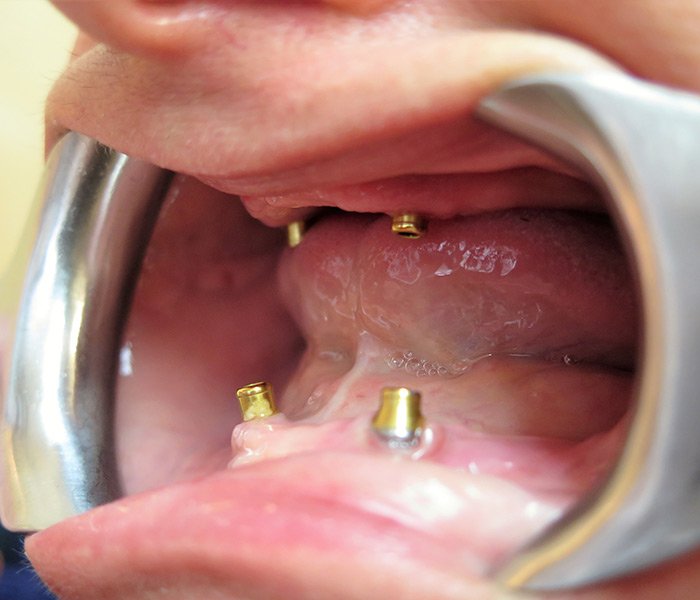 Before All-on-4 treatment, patient case 3 at Dentist of Torrance