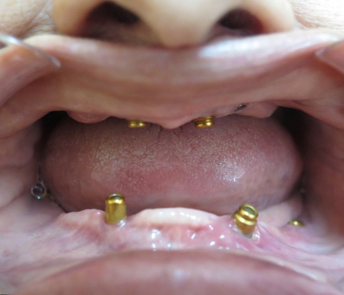 Before All-on-4 treatment, patient case 4 at Dentist of Torrance