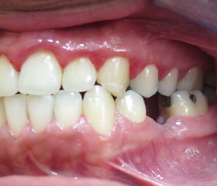 Before dental implant treatment, patient case 2 at Dentist of Torrance