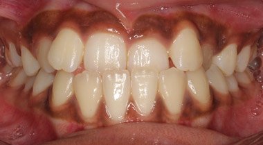 Before orthodontic treatment, patient case 1 at Dentist of Torrance