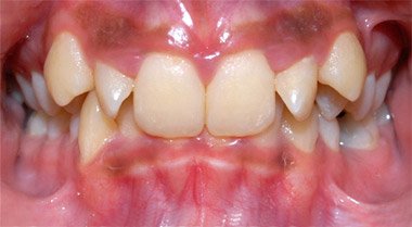 Before orthodontic treatment, patient case 2 at Dentist of Torrance