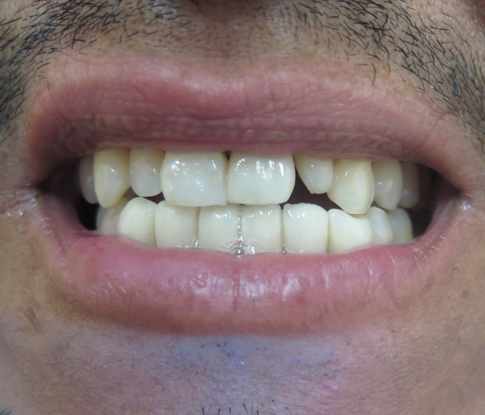 Before porcelain veneers, patient case 2 at Dentist of Torrance