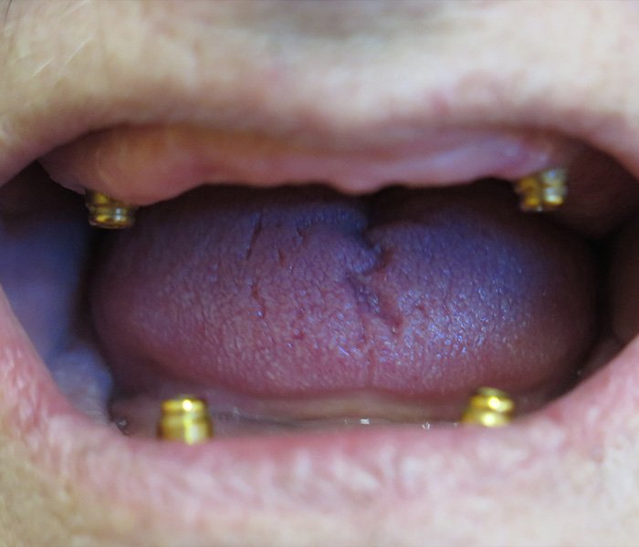 Before All-on-4 treatment, patient case 1 at Dentist of Torrance