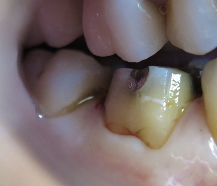 Before dental crown treatment, patient case 1 at Dentist of Torrance