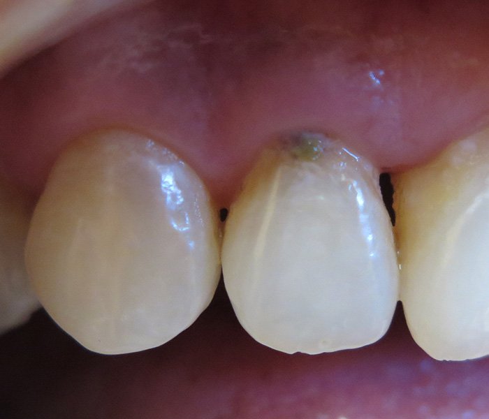 Before composite filling treatment, patient case 2 at Dentist of Torrance