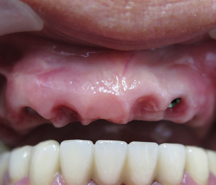 Before dental implant treatment, patient case 3 at Dentist of Torrance