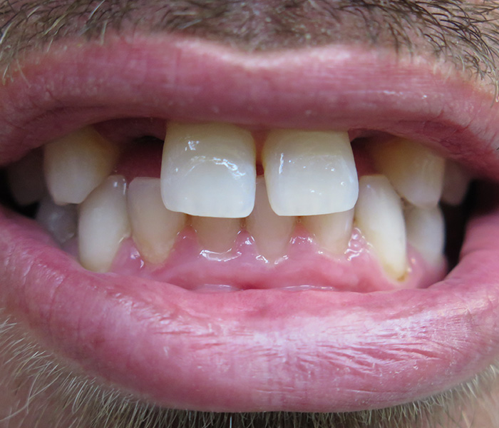 Before dental implant treatment, patient case 4 at Dentist of Torrance