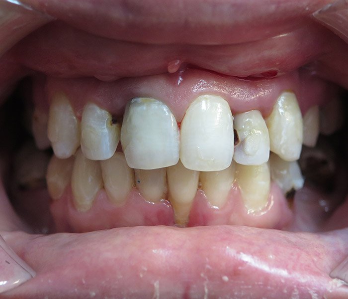 Before dental implant treatment, patient case 1 at Dentist of Torrance