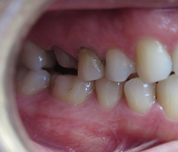 Before dental crown treatment, patient case 2 at Dentist of Torrance