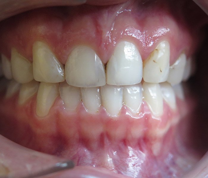 Before porcelain veneers, patient case 1 at Dentist of Torrance