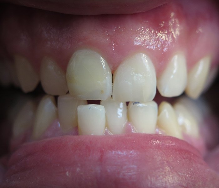 After composite filling treatment, patient case 1 at Dentist of Torrance
