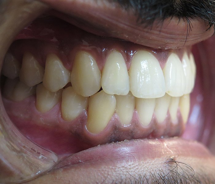 After professional teeth cleaning, patient case 3 at Dentist of Torrance