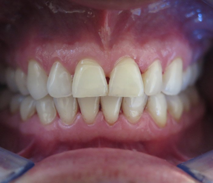 After professional teeth cleaning, patient case 4 at Dentist of Torrance