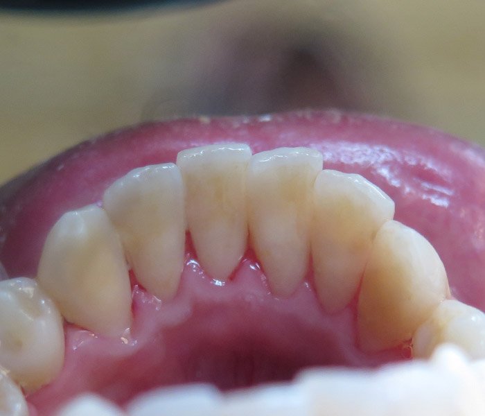 After professional teeth cleaning, patient case 2 at Dentist of Torrance