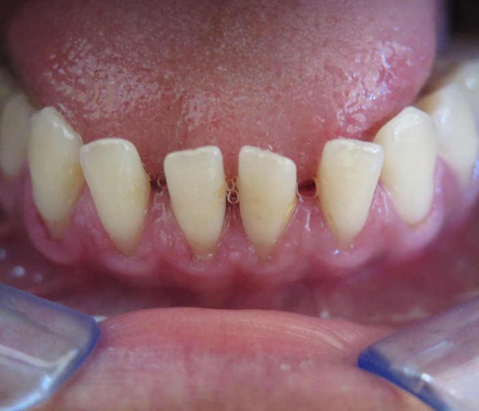 After professional teeth cleaning, patient case 1 at Dentist of Torrance