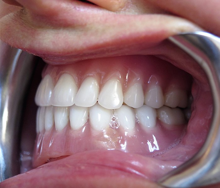 After All-on-4 treatment, patient case 3 at Dentist of Torrance