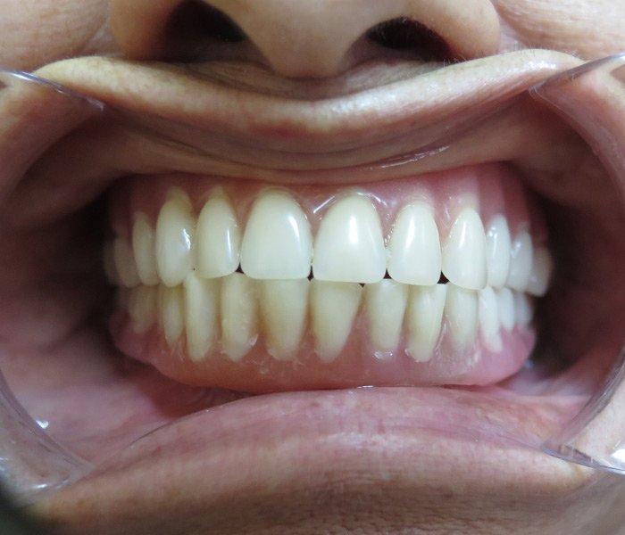 After All-on-4 treatment, patient case 4 at Dentist of Torrance