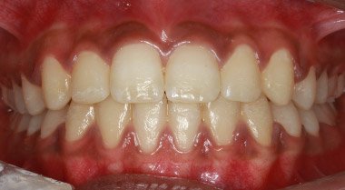 After orthodontic treatment, patient case 1 at Dentist of Torrance
