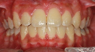 After orthodontic treatment, patient case 2 at Dentist of Torrance