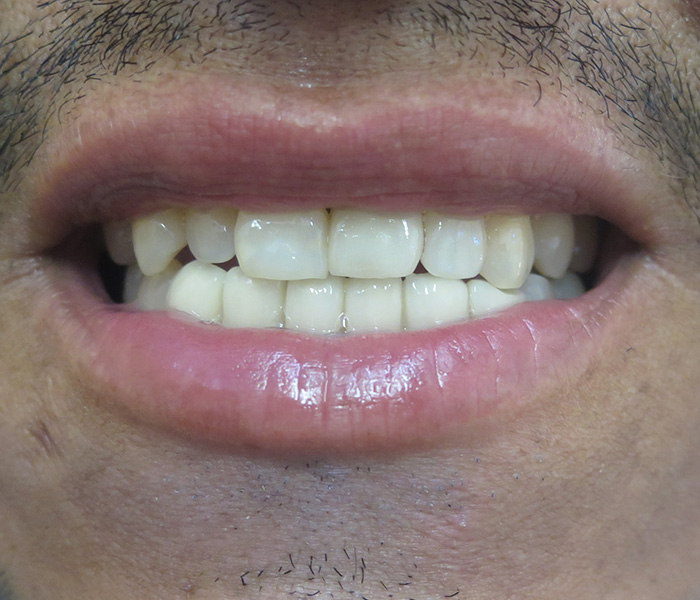 After porcelain veneers, patient case 2 at Dentist of Torrance