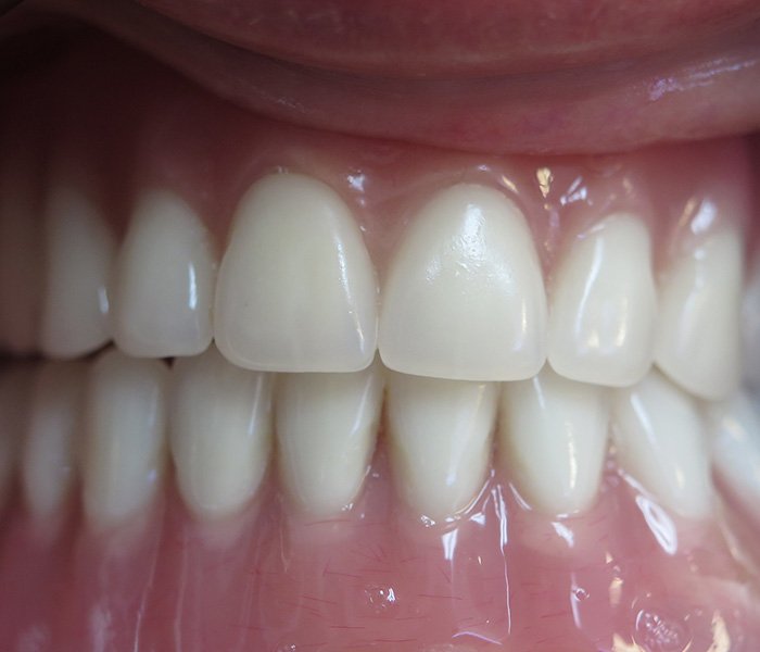 After All-on-4 treatment, patient case 2 at Dentist of Torrance