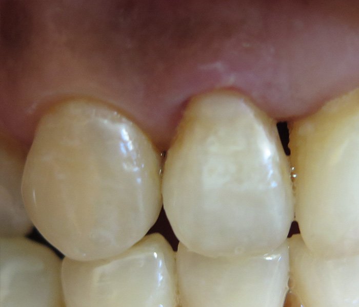 After composite filling treatment, patient case 2 at Dentist of Torrance