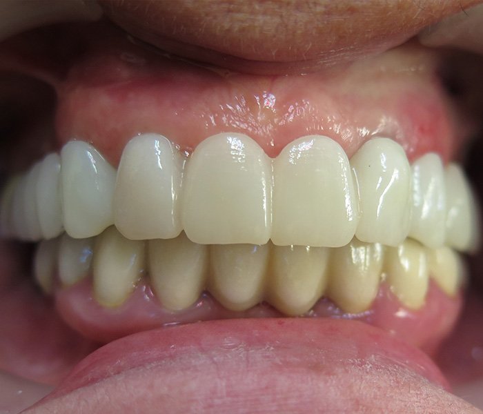 After dental implant treatment, patient case 3 at Dentist of Torrance