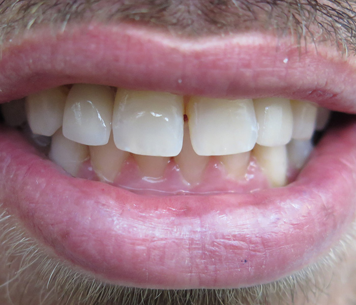 After dental implant treatment, patient case 4 at Dentist of Torrance