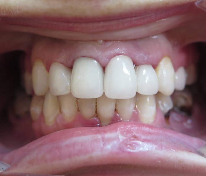 After dental implant treatment, patient case 1 at Dentist of Torrance