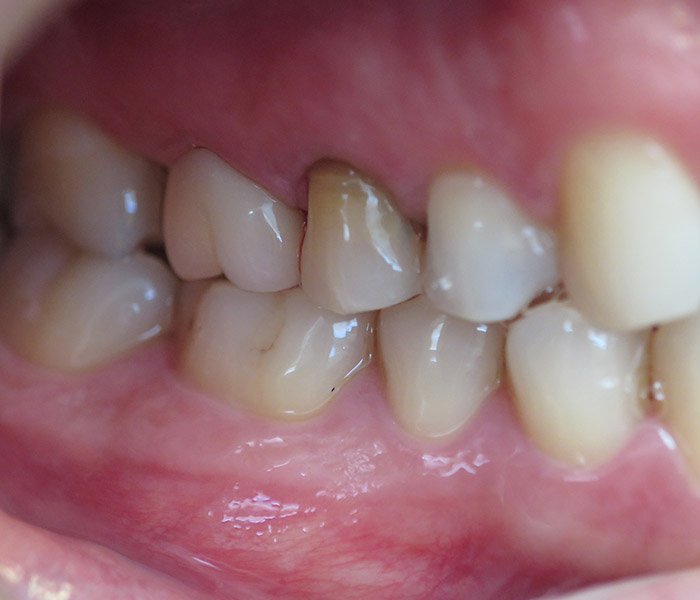 After dental crown treatment, patient case 2 at Dentist of Torrance