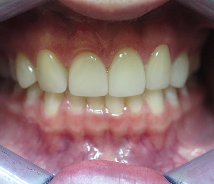 After porcelain veneers, patient case 1 at Dentist of Torrance