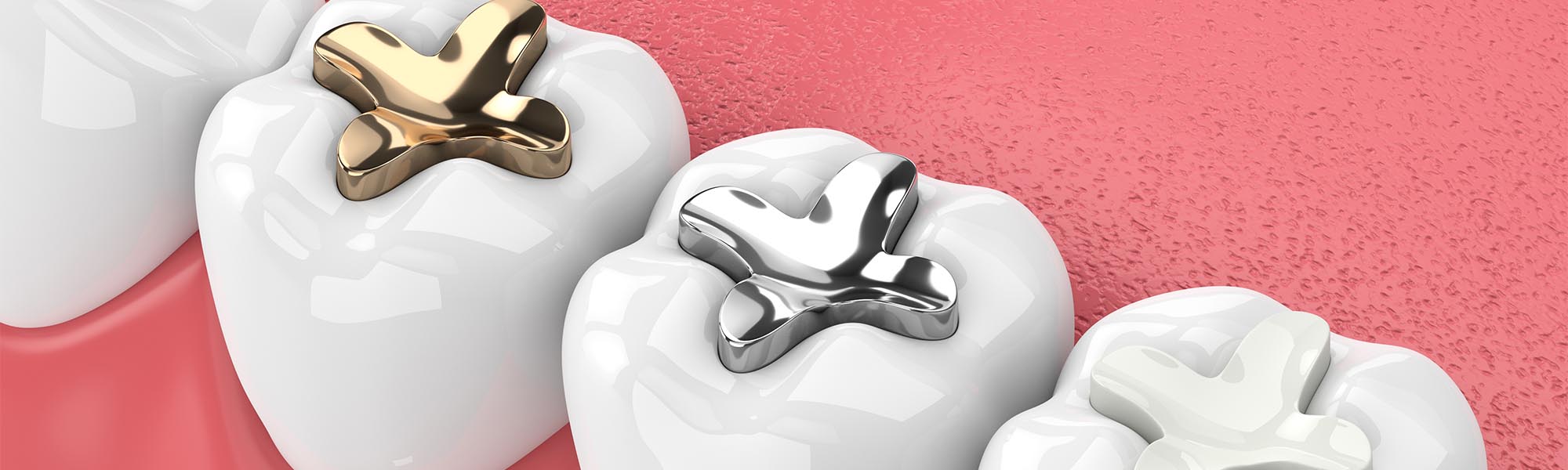 Composite Fillings Torrance CA