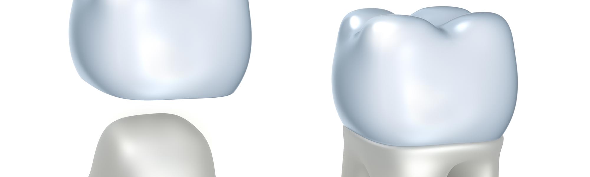 Porcelain Crowns Torrance CA