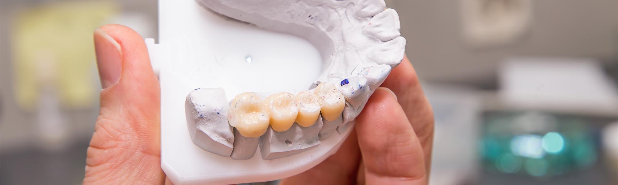 Fixed Bridges in Torrance CA