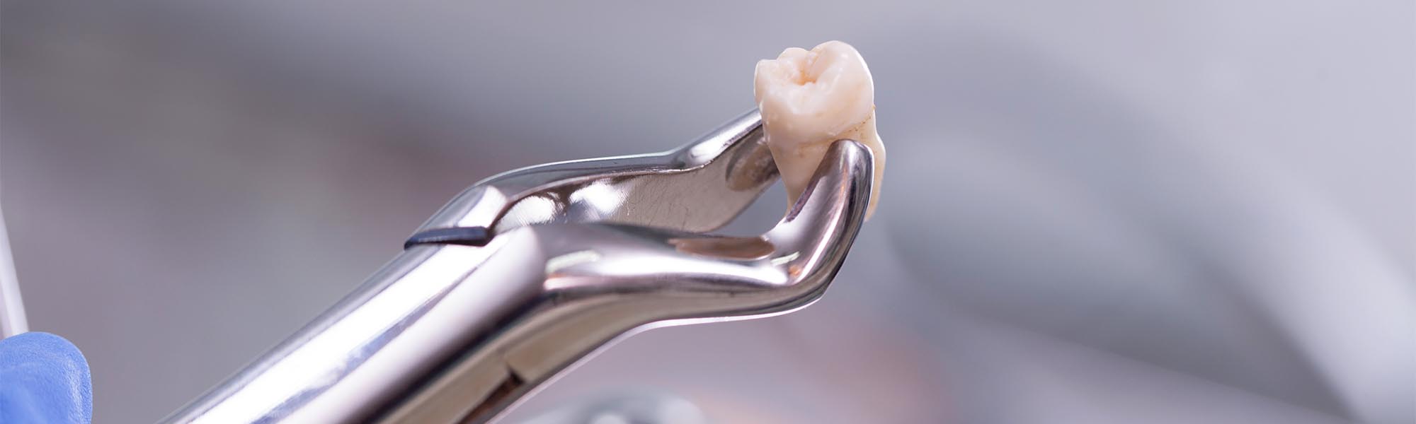 Tooth Extraction in Torrance CA