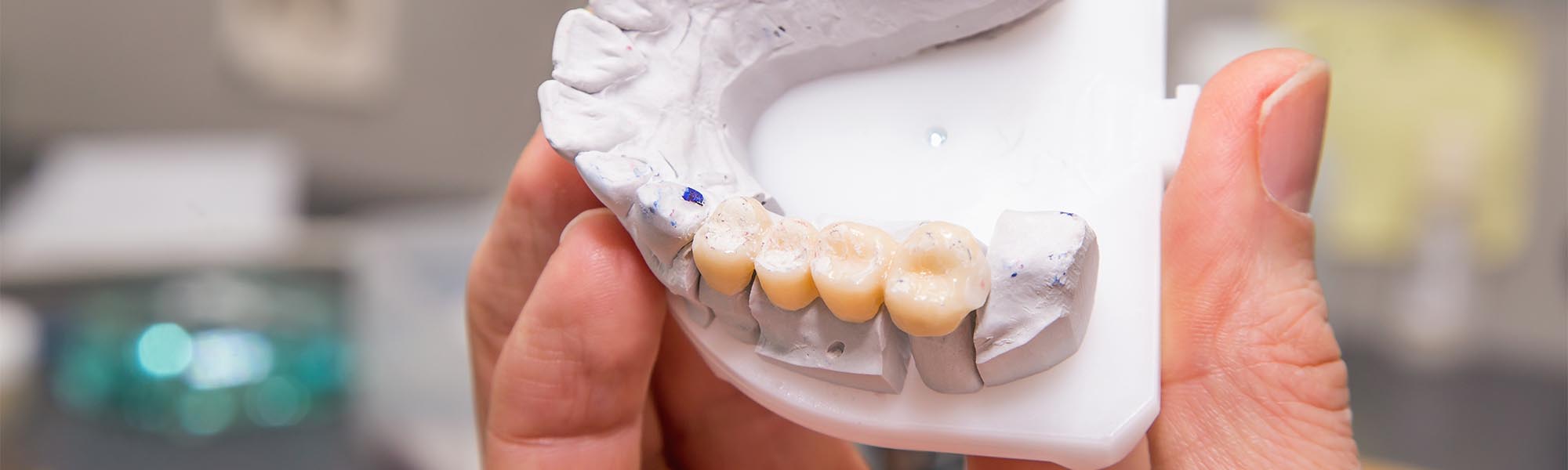 Porcelain Fixed Bridges Process Torrance CA