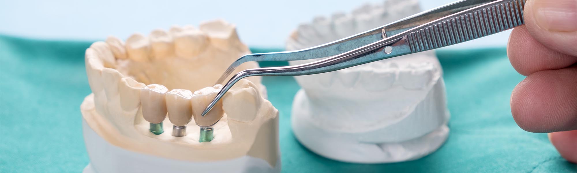 Porcelain Fixed Bridges Torrance CA