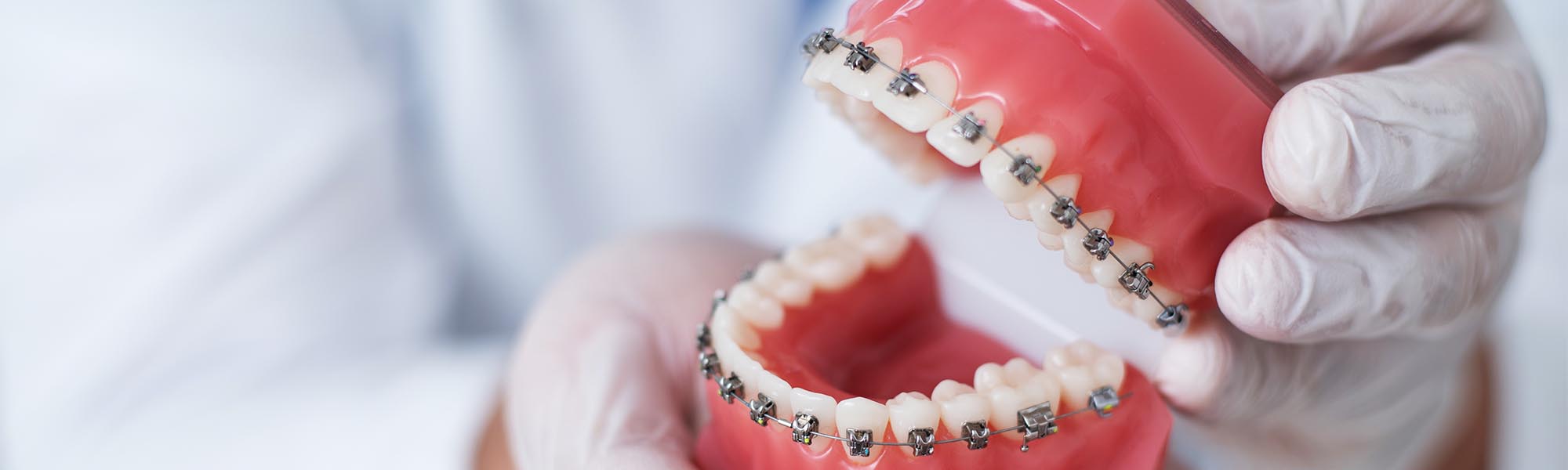 Metal Braces Torrance CA