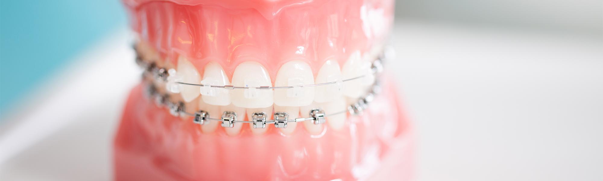 Porcelain Ceramic Braces in Torrance CA
