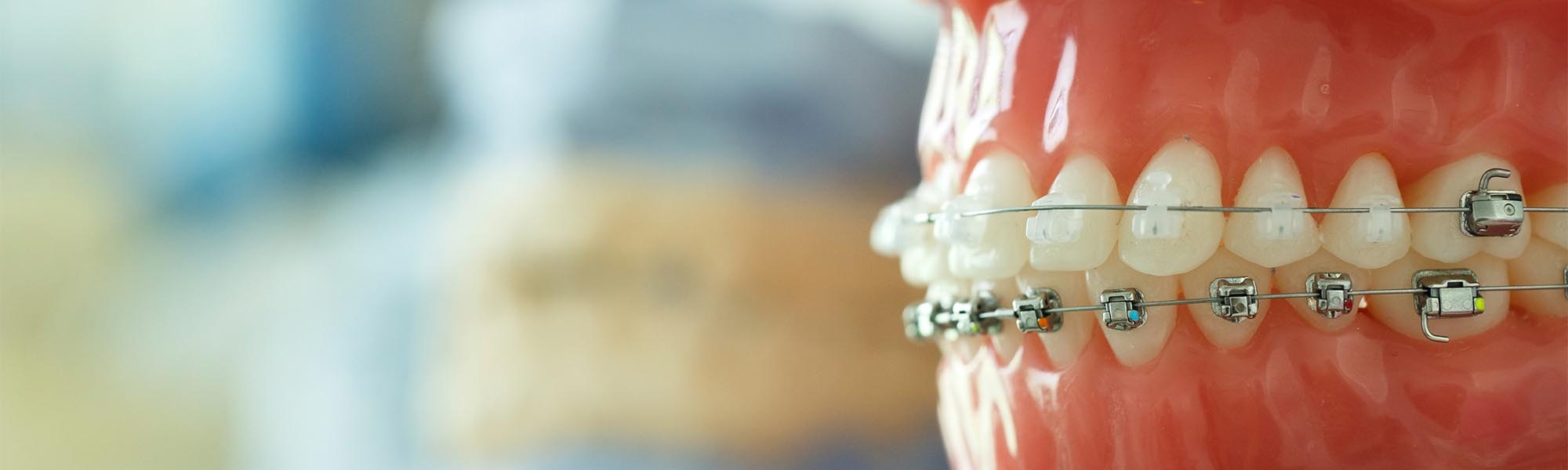 Porcelain Ceramic Braces Torrance CA