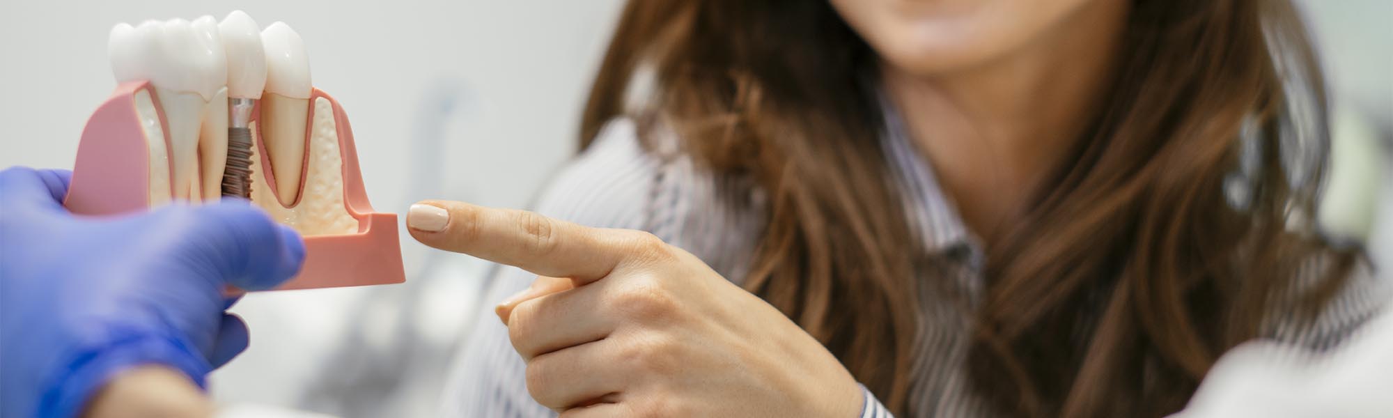 Multiple Teeth Implants Dentistry Torrance CA