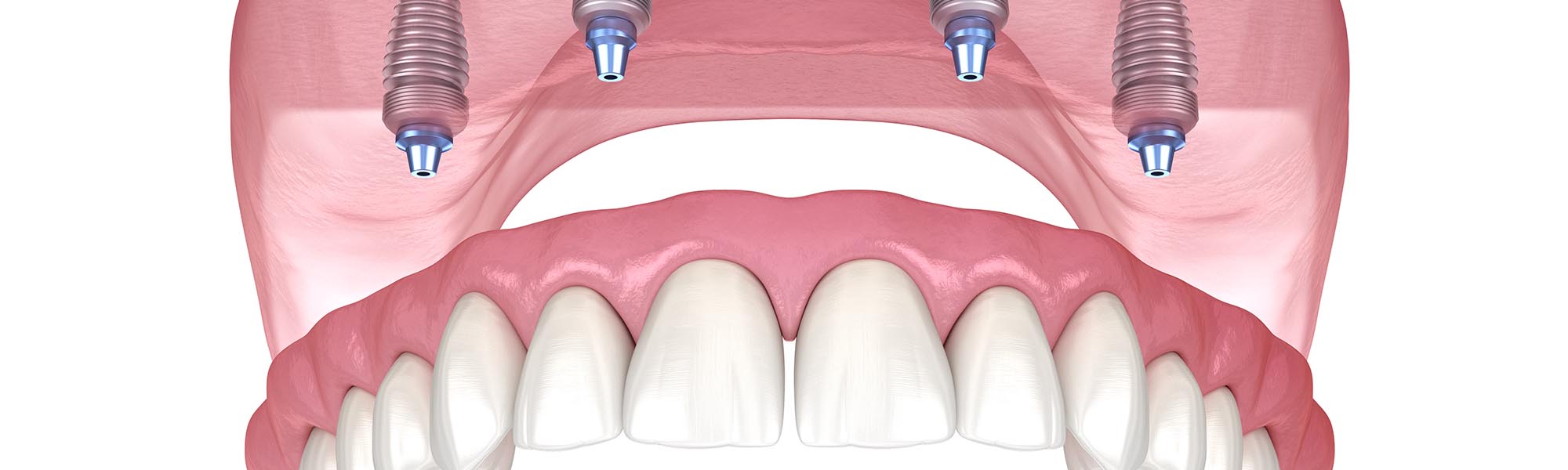 Multiple Teeth Implants in Torrance CA